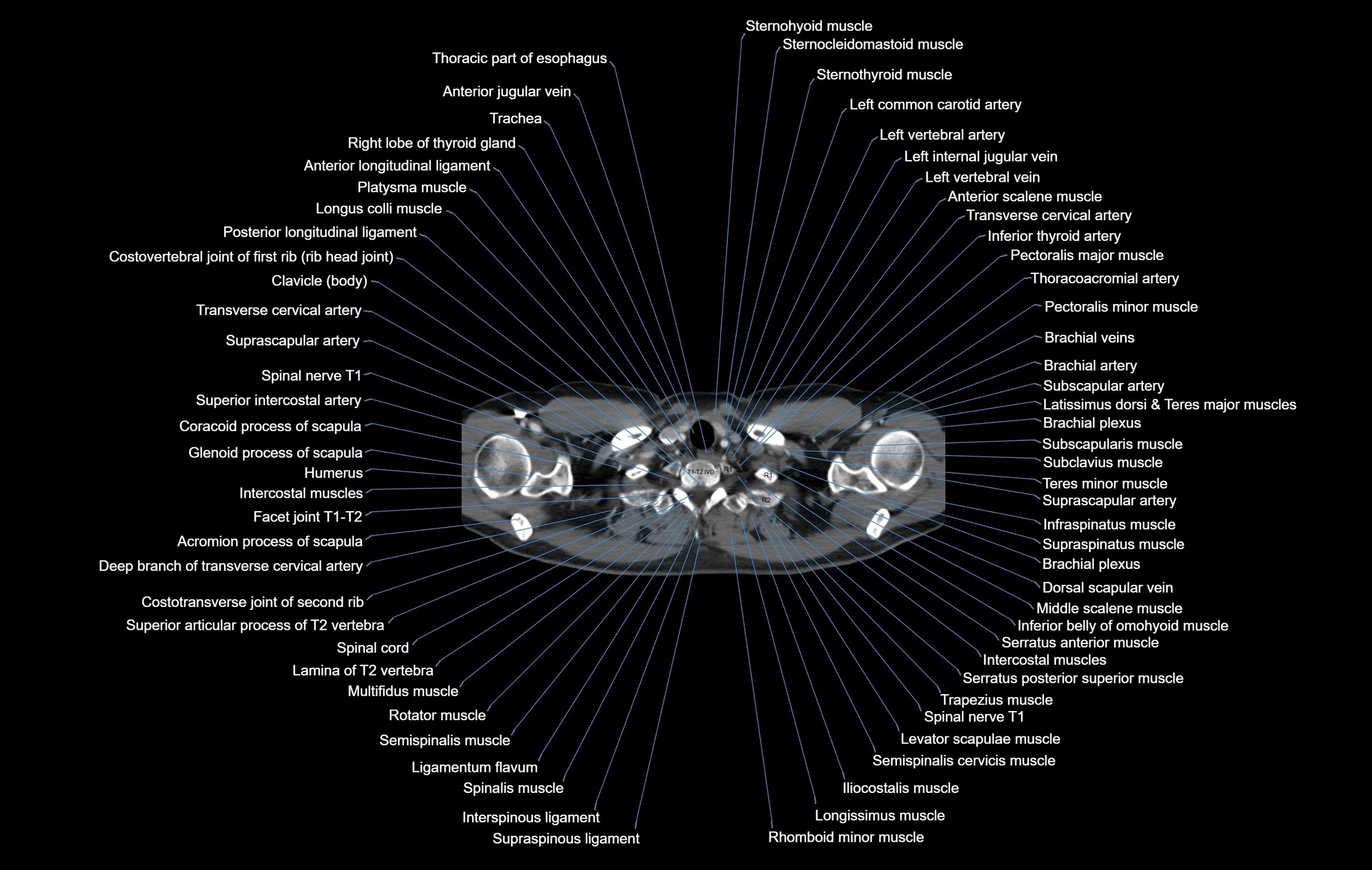 CT chest (thorax) soft tissue window labelled axial cross sectional anatomy radiology image-00006.webp